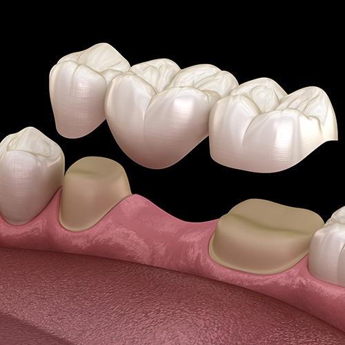 Illustration of dental bridge being attached to teeth