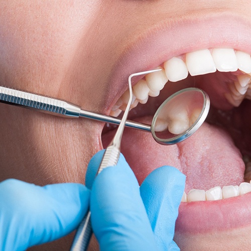 Close-up of a dental checkup in Fort Myers, FL