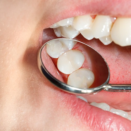 Dental crowns have many benefits including the ability to blend in with your natural teeth