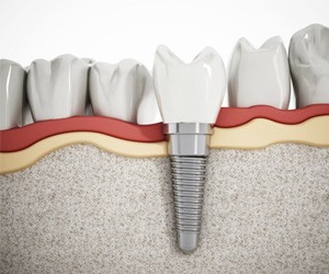 a 3 D illustration of a dental implant 