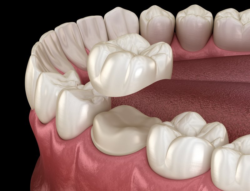 An illustration of a dental crown being placed over a prepared tooth